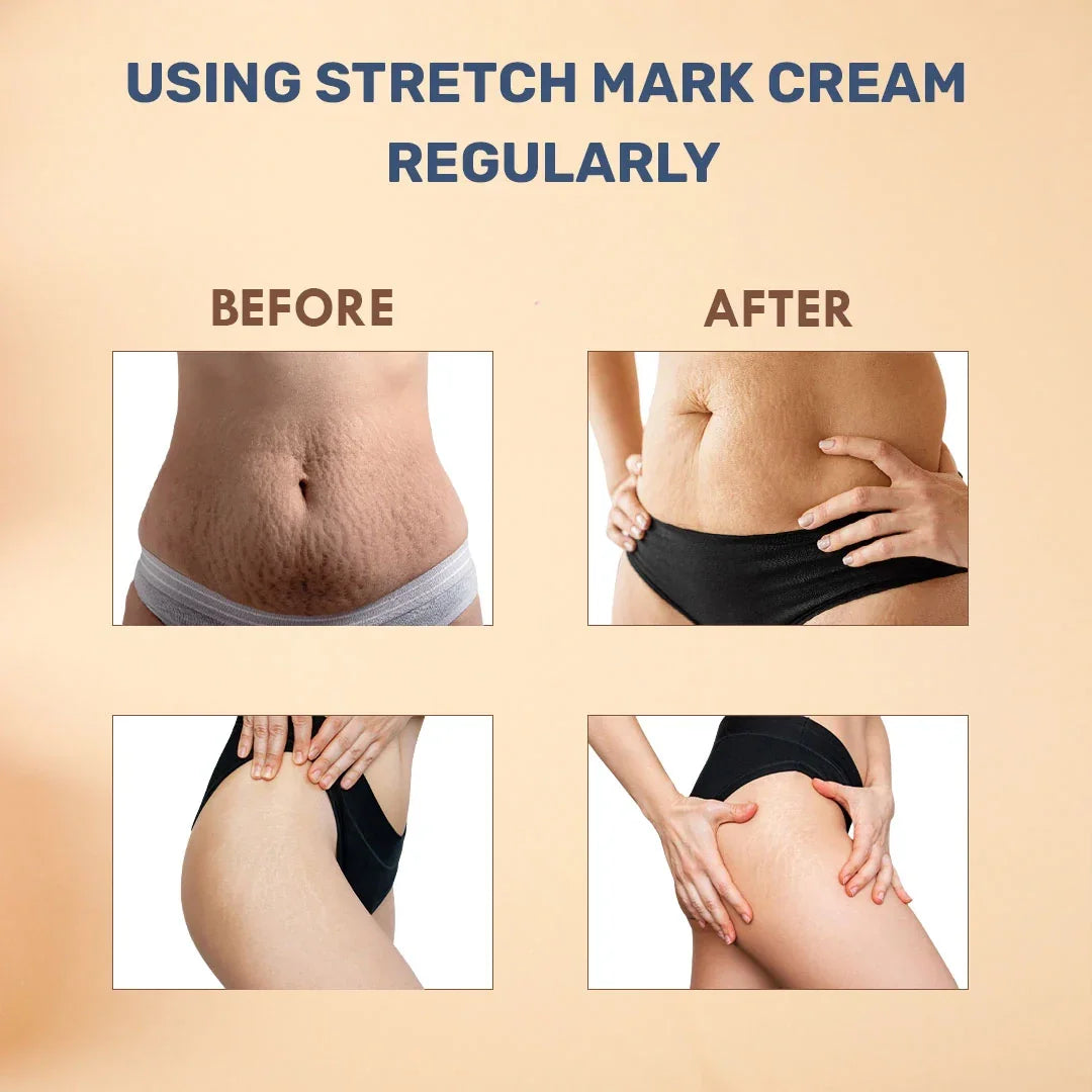 Natural Stretch Mark Cream for Women & Men - 50gm - Veda Harvest 