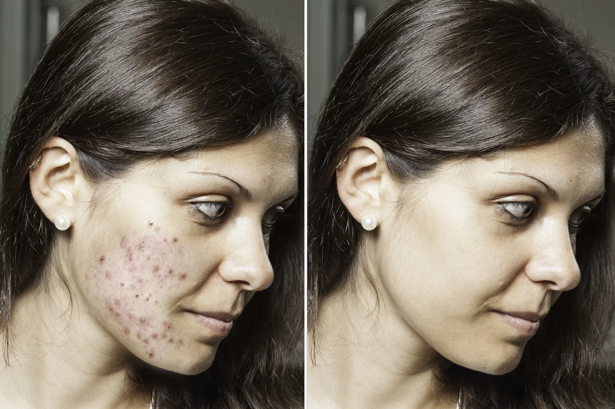 young-woman-with-brunette-hair-shows-before-after-results-successful-acne-treatment-spots-scars-have-been-removed-through-application-prescribed-topical-creams