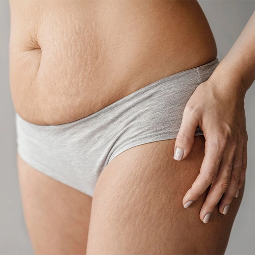 Reduce-Stretch-Marks